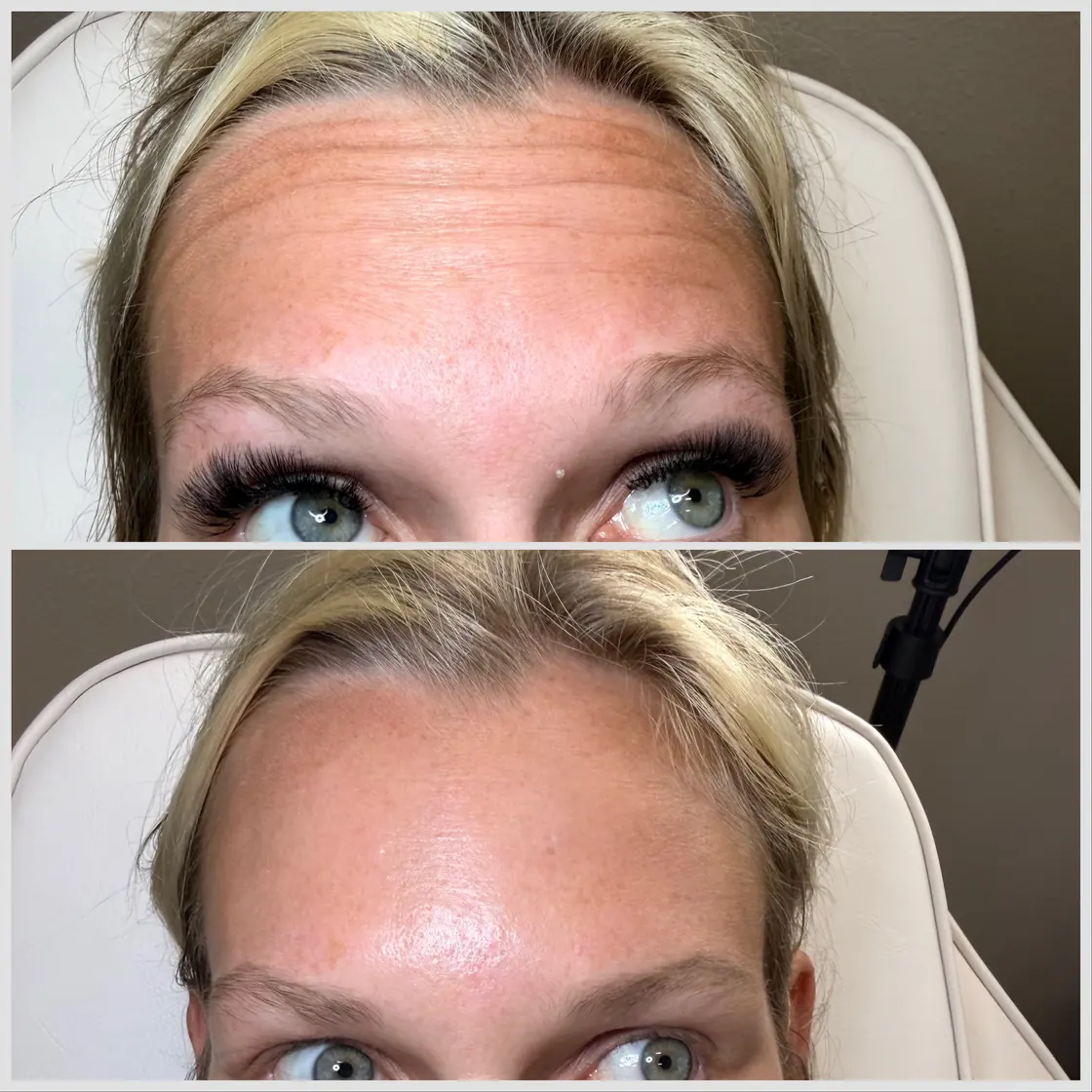 Before and after Botox for forehead lines at KM RX Aesthetics, Bellaire TX