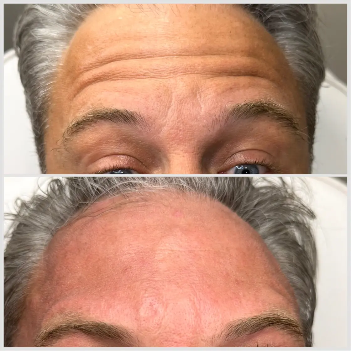 Before and after Botox for forehead lines, male client at KM RX Aesthetics, Bellaire TX