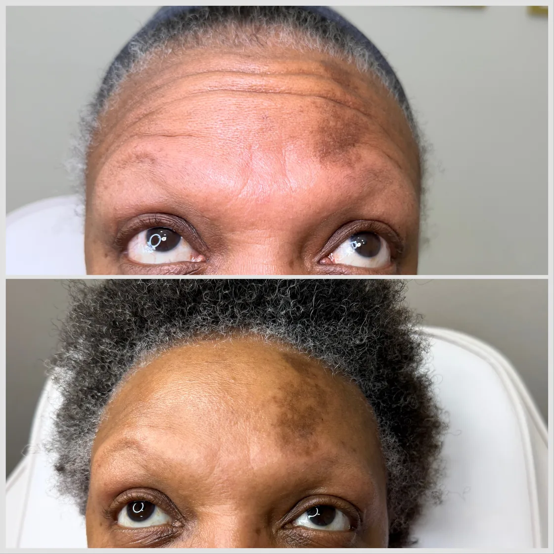 Before and after Botox for forehead lines at KM RX Aesthetics, Bellaire TX
