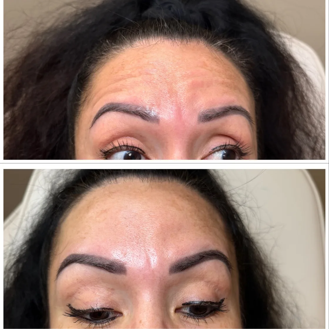 Before and after Botox for forehead and frown lines at KM RX Aesthetics, Bellaire TX