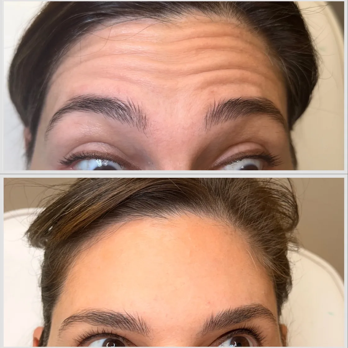 Before and after Botox for forehead lines at KM RX Aesthetics, Bellaire TX