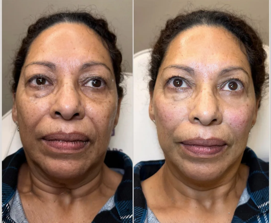 Before and after cheek and midface dermal filler at KM RX Aesthetics, Bellaire TX