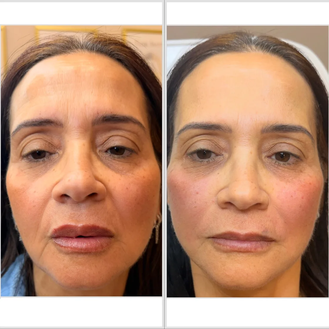 Before and after facial balancing with dermal filler at KM RX Aesthetics, Bellaire TX