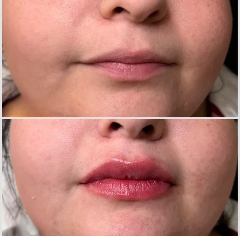 Before and after lip filler, hydrated fuller lips at KM RX Aesthetics, Bellaire TX
