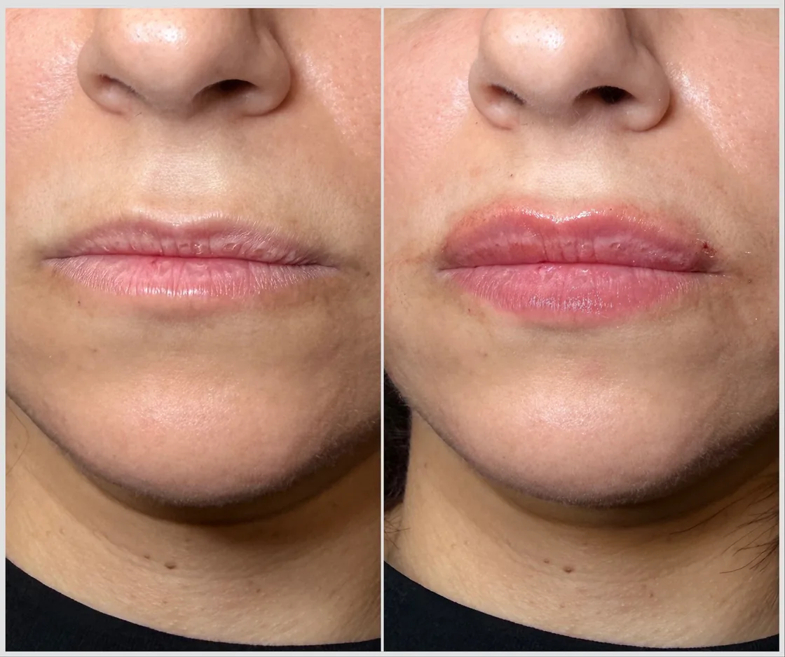 Before and after lip filler, subtle volume and definition at KM RX Aesthetics, Bellaire TX