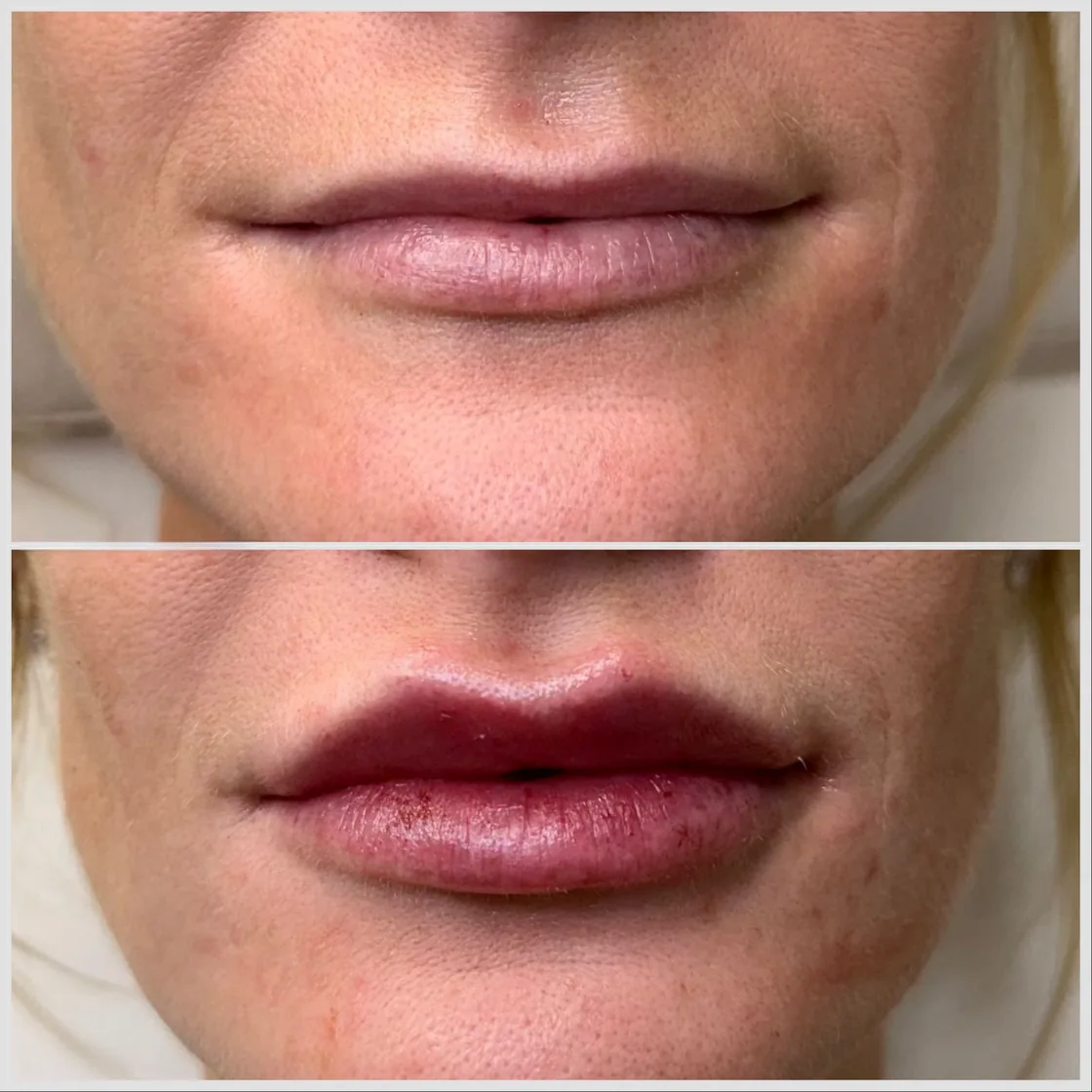 Before and after lip filler, natural shape at KM RX Aesthetics, Bellaire TX