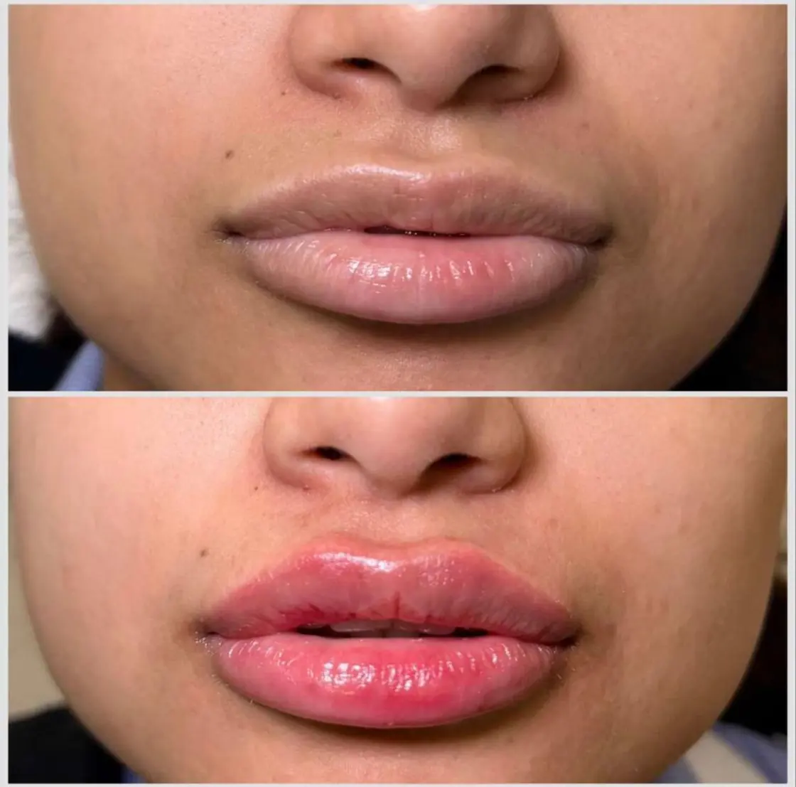 Before and after lip filler at KM RX Aesthetics, Bellaire TX