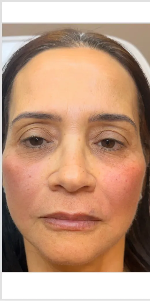 Face after dermal filler for balancing, KM RX Aesthetics client