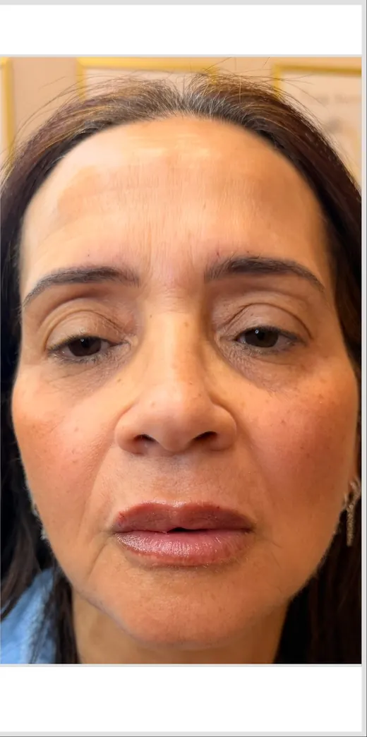 Face before dermal filler for balancing, KM RX Aesthetics client