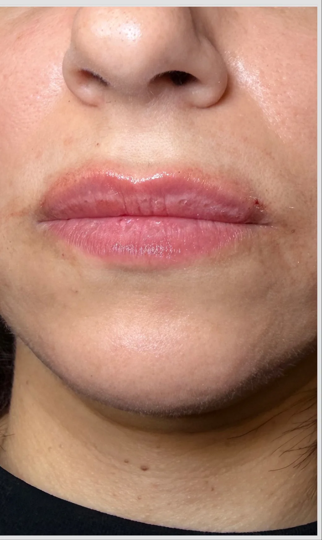 Lips after lip filler, KM RX Aesthetics client