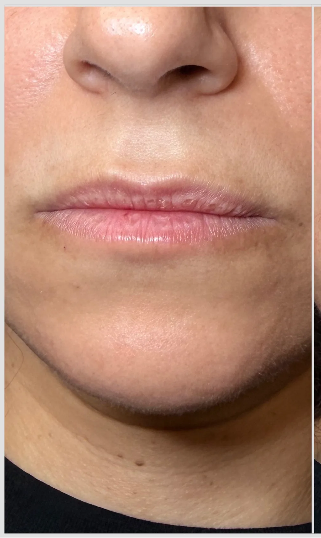 Lips before lip filler, KM RX Aesthetics client